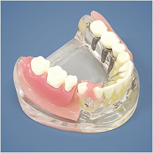Kh66zky שיניים השתלת 3 מודל שתל ציפורניים מודל מנתק מנתק לחינוך, תקשורת מטופלים, למידה ומעבדה